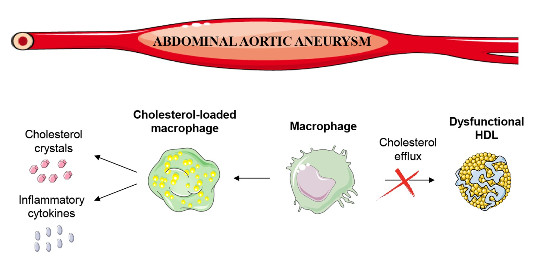 enfermedades de aneurisma abdominal